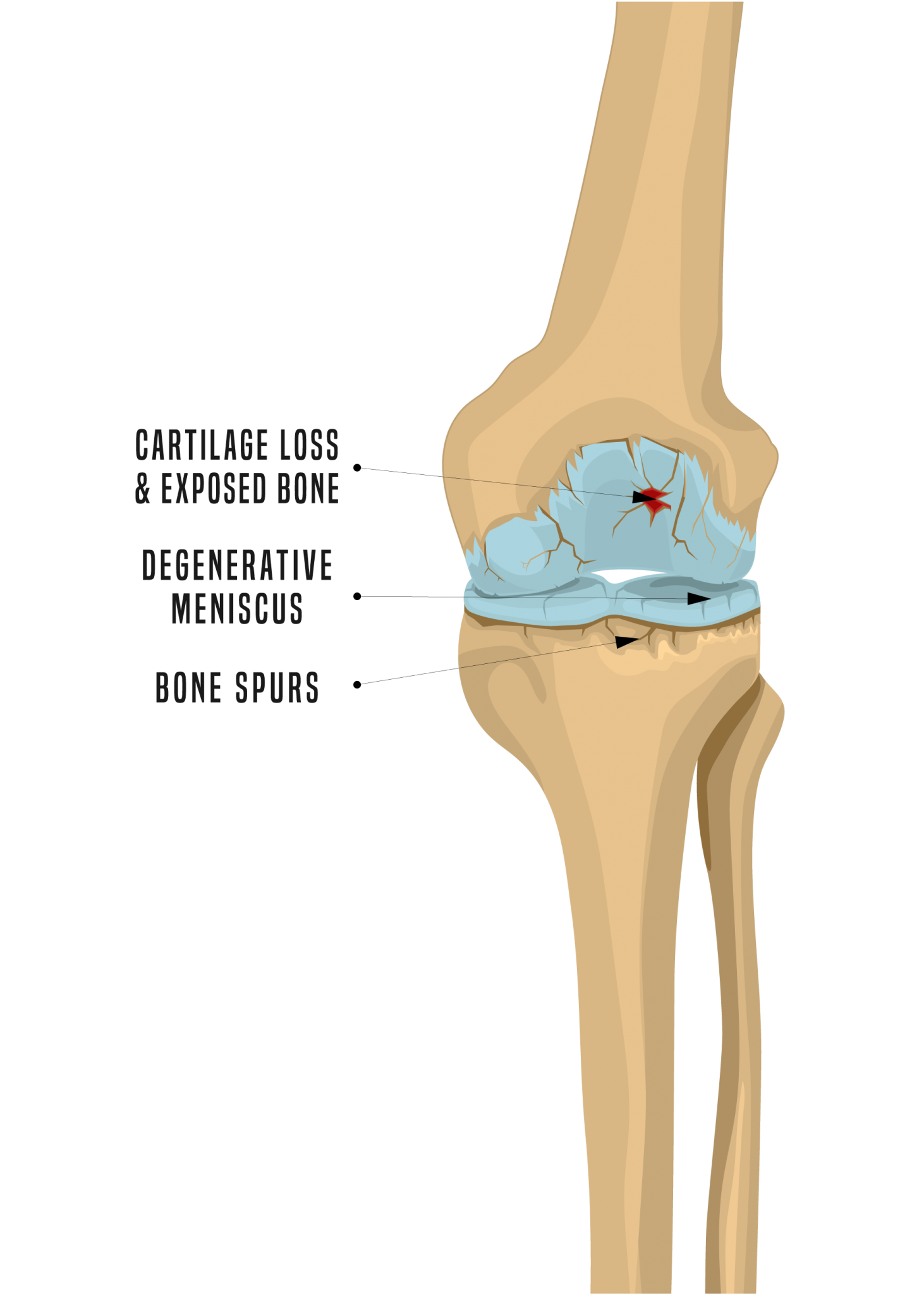 Arthritis & Knee Pain Center of Lexington explains Osteoarthritis